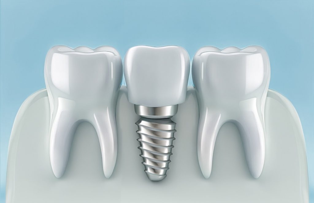 dental implants in mill bay