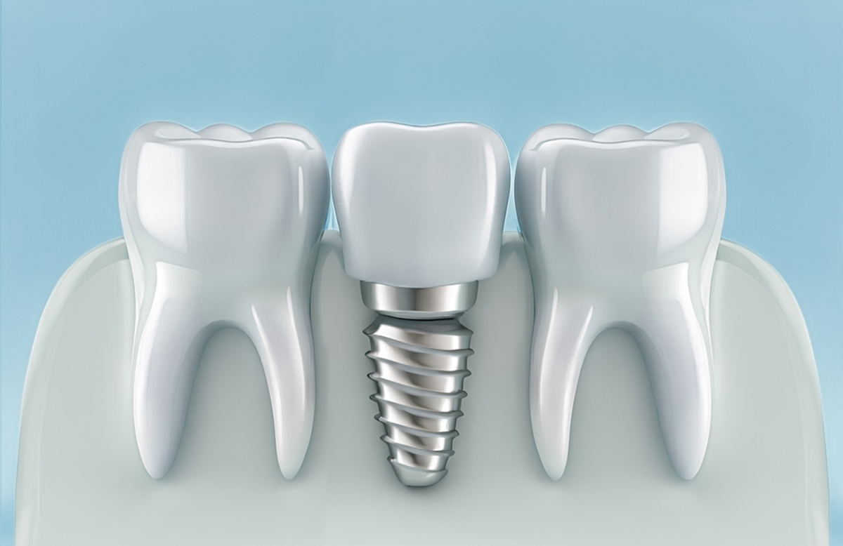 dental implants in mill bay