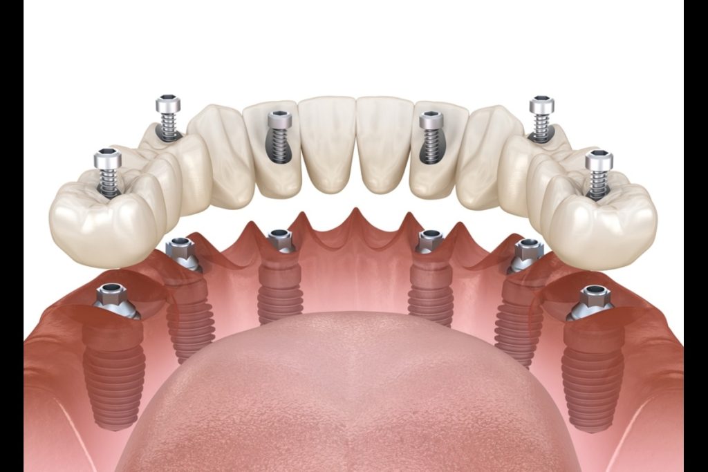 dental implants in mill bay