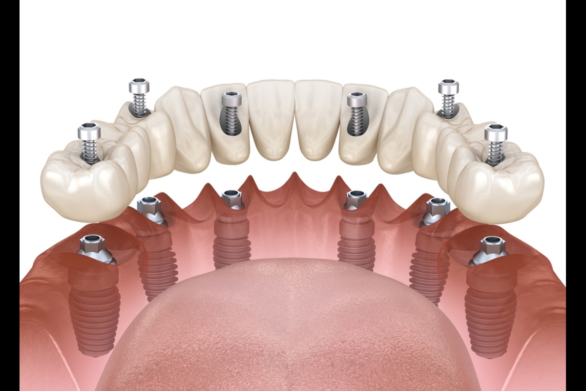 dental implants in mill bay