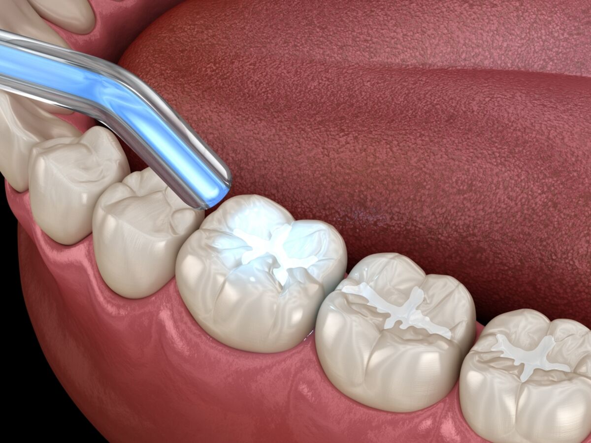 composite dental fillings in mill bay