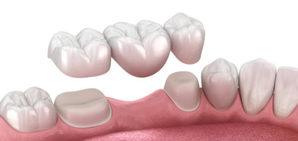 dental crowns
