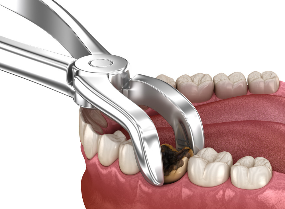 wisdom teeth removal