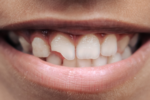 An Emergency Dentist Discusses Broken Teeth
