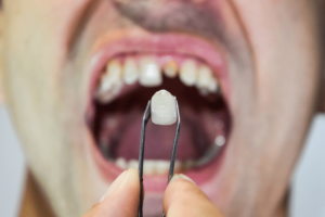 Harmony in Dentistry Your Guide to Tailoring Tooth Replacement for a Perfect Smile-