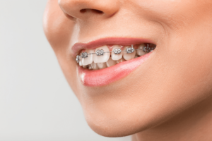Orthodontics Can Straighten Your Smile At Any Age-