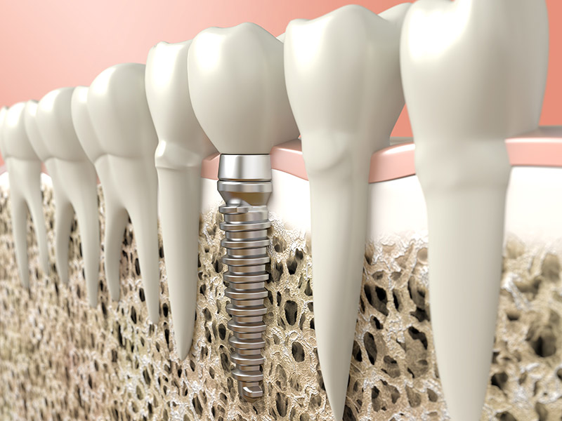 dental implants in mill bay