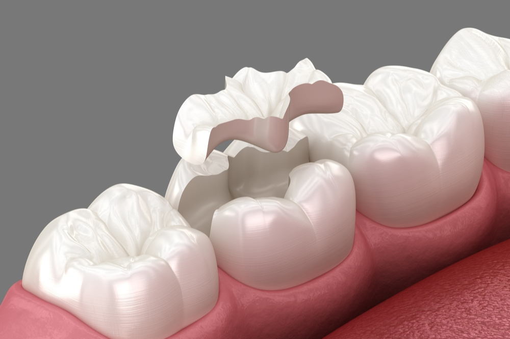 inlays and onlays restoring primary teeth for healthy development